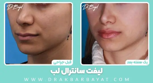 لیفت سانترال لب