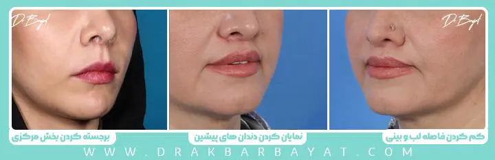 جراحی لیفت سانترال لب