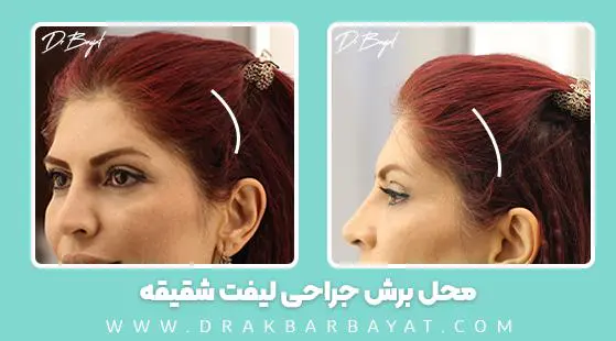 محل برش لیفت شقیقه