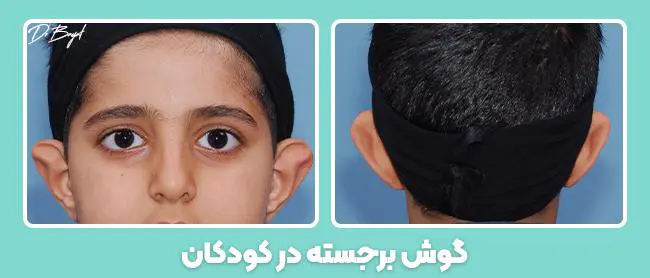 چگونه گوش نوزاد را خوش فرم کنیم
