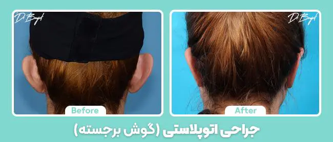 جراحی گوش برجسته توسط بهترین جراح زیبایی تهران