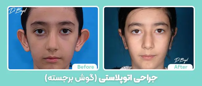 جراحی اتوپلاستی