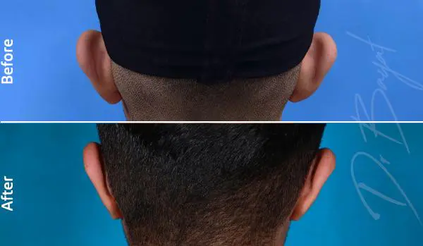نمونه کار جراحی گوش برجسته جراح دکتر اکبربیات