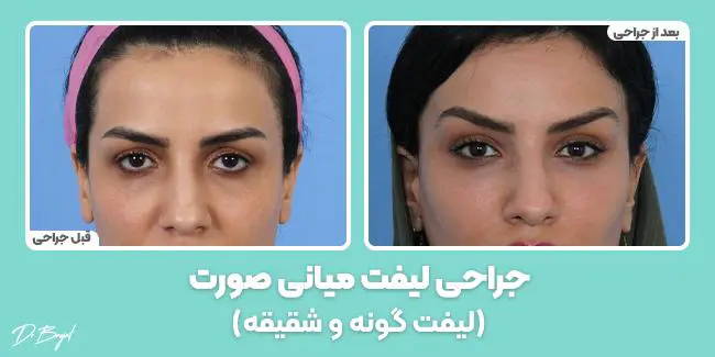 نمونه کار جراحی لیفت میانی صورت (لیفت گونه)