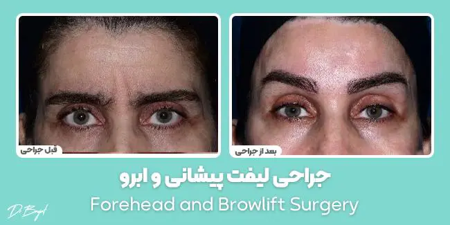 جراحی لیفت پیشانی