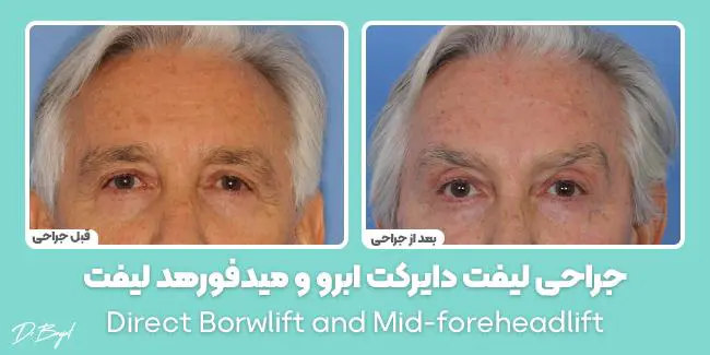 جراحی لیفت دایرکت ابرو
