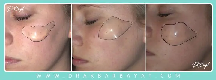 جراحی پروتز گونه و برجسته سازی گونه
