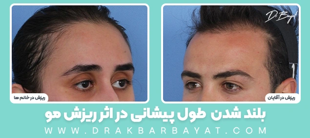 لیفت پیشانی 