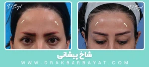 شاخ پیشلنی