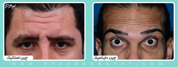جراحی لیفت اندوسکوپیک پیشانی