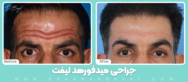 جراحی لیفت وسط پیشانی یا میدفورهِد در تهران