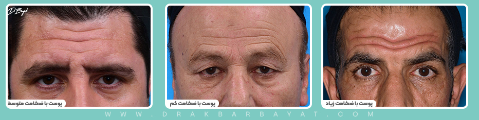 جراحی لیفت اندوسکوپیک پیشانی در سعادت آباد