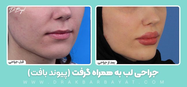 حجیم سازی لب(برجسته سازی لب) با استفاده از بافت بدن
