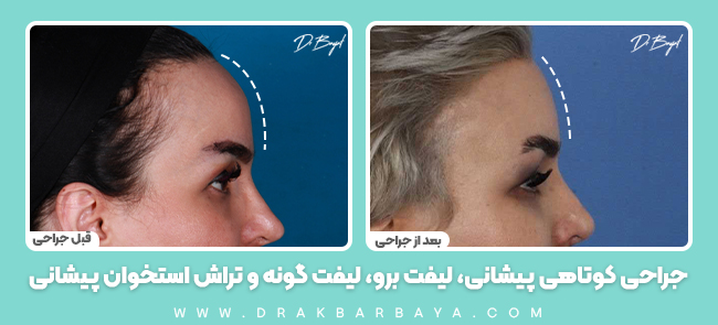 جراحی کوتاهی پیشانی