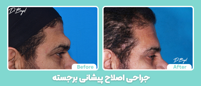 جراحی اصلاح پیشانی برجسته نمونه کار
