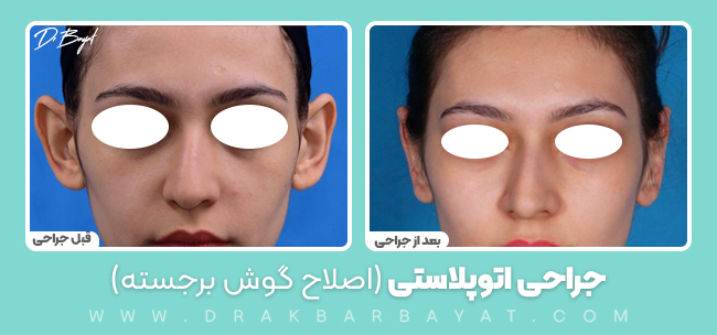 اصلاح گوش برجسته