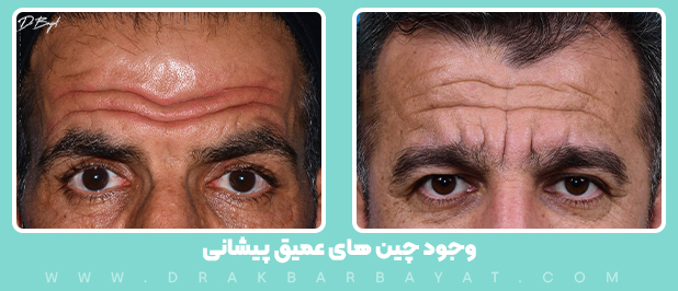 لیفت میدفورهد با برش در وسط پیشانی