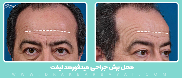 جراحی لیفت میدفورهد