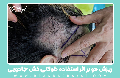 ریزش مو بر اثر استفاده از کش جادویی