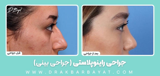 جراحی راینوپلاستی |جراحی بینی