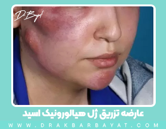 بهترین جراح تخلیه ژل صورت