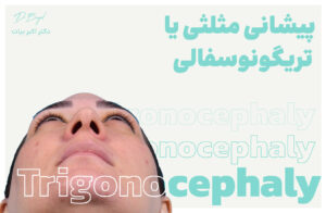 پیشانی مثلثی