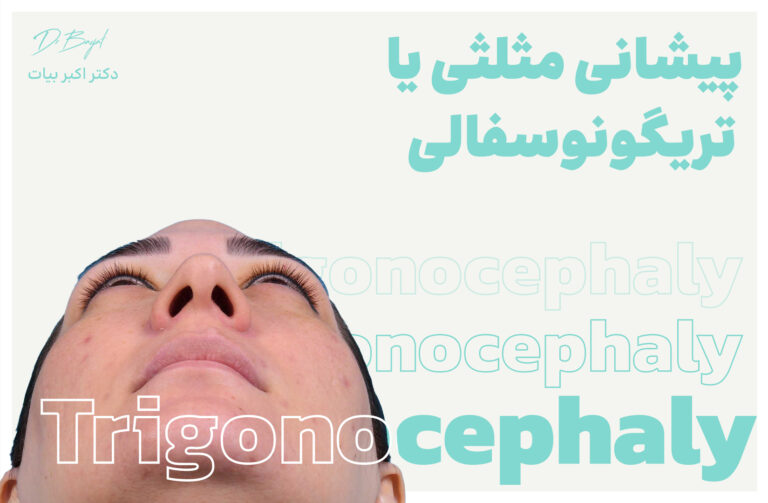 پیشانی مثلثی