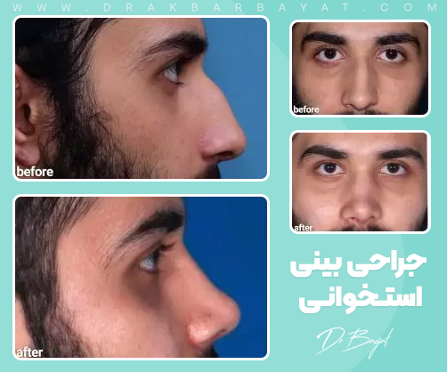 جراحی بینی استخوانی