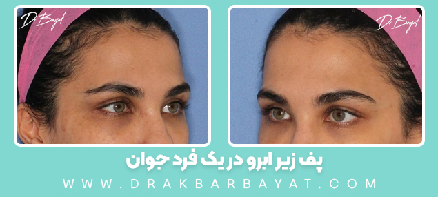پف زیر ابرو در یک فرد جوان