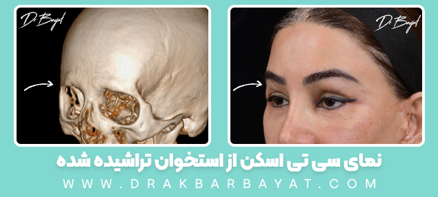 نمای سی تی اسکن از استخوان تراشیده شده