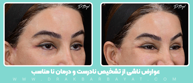 عوارض ناشی از تشخیص نادرست و درمان نامناسب |لیفت زیر ابرو