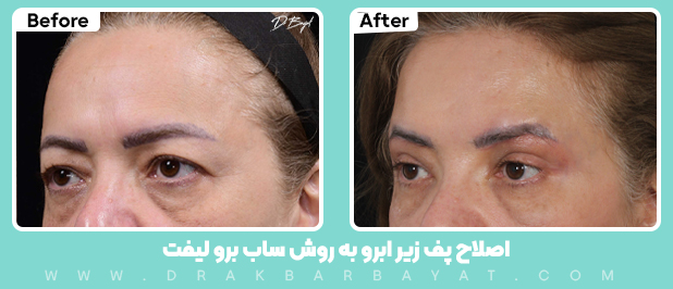جراحی لیفت زیر ابرو در تهران