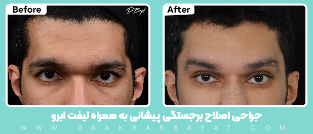 لیفت ابرو در آقایان