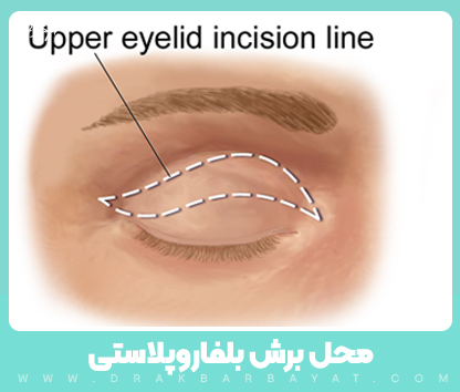 محل برش بلفاروپلاستی