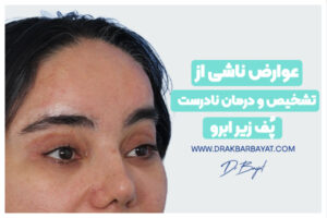 درمان نادرست پف زیر ابرو