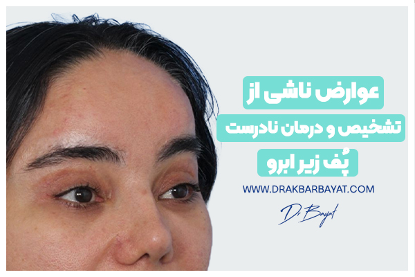 درمان نادرست پف زیر ابرو