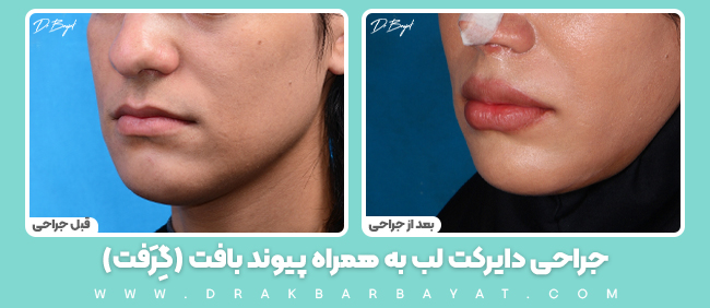 جراحی دایرکت لب( پیوند بافت گرفت)