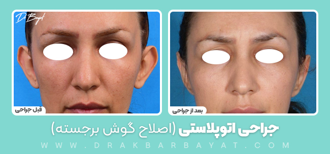 جراحی اتوپلاسی +جراحی زیبایی گوش