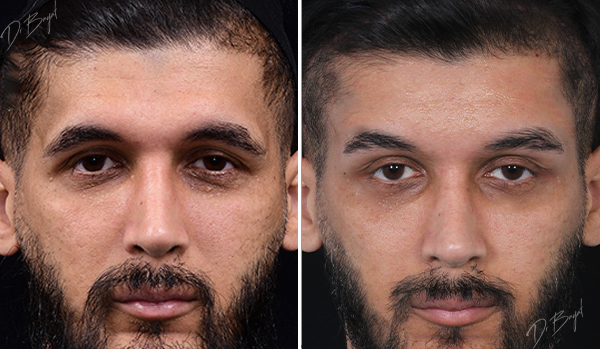 جراحی لیفت پیشانی در تهران