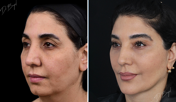 جراحی لیفت پیشانی