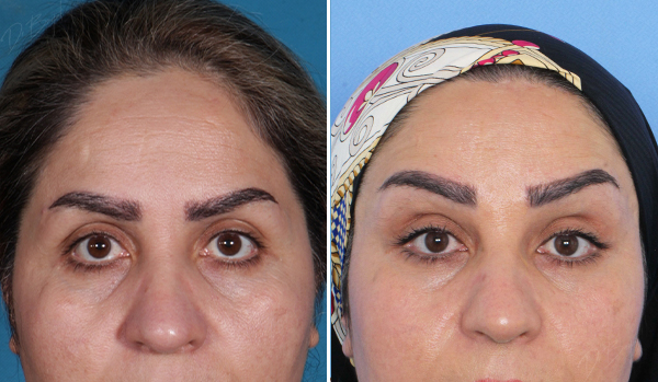 لیفت پیشانی