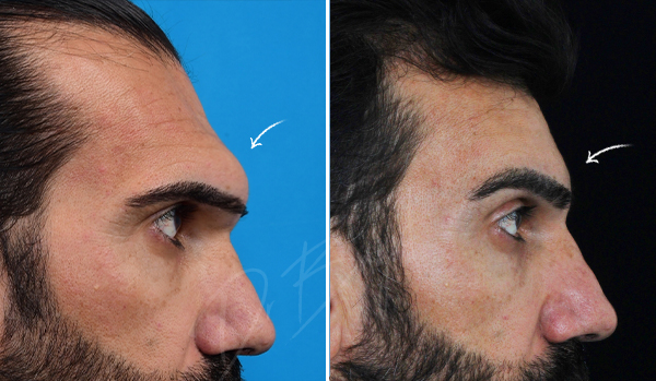 جراحی پیشانی برجسته در تهران