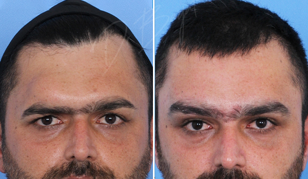 جراحی پیشانی برجسته