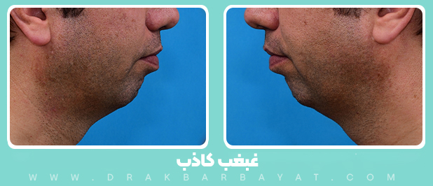 غبغب کاذب