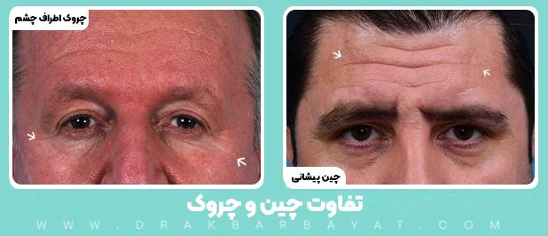 لیفت صورت بهترین روش برای از بین بردن چین و چروک 