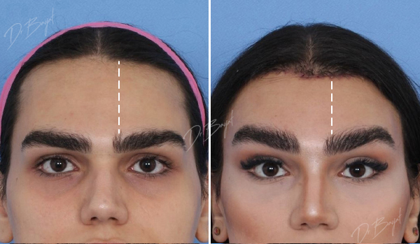 جراحی کوتاهی پیشانی