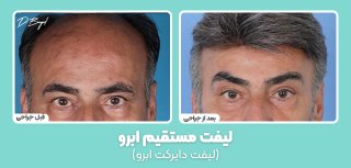 لیفت مستقیم ابرو