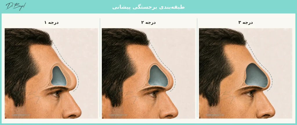 تصویر آموزشی مقایسه درجات ۱، ۲ و ۳ برجستگی پیشانی براساس ضخامت دیواره قدامی و اندازه حفره سینوس پیشانی