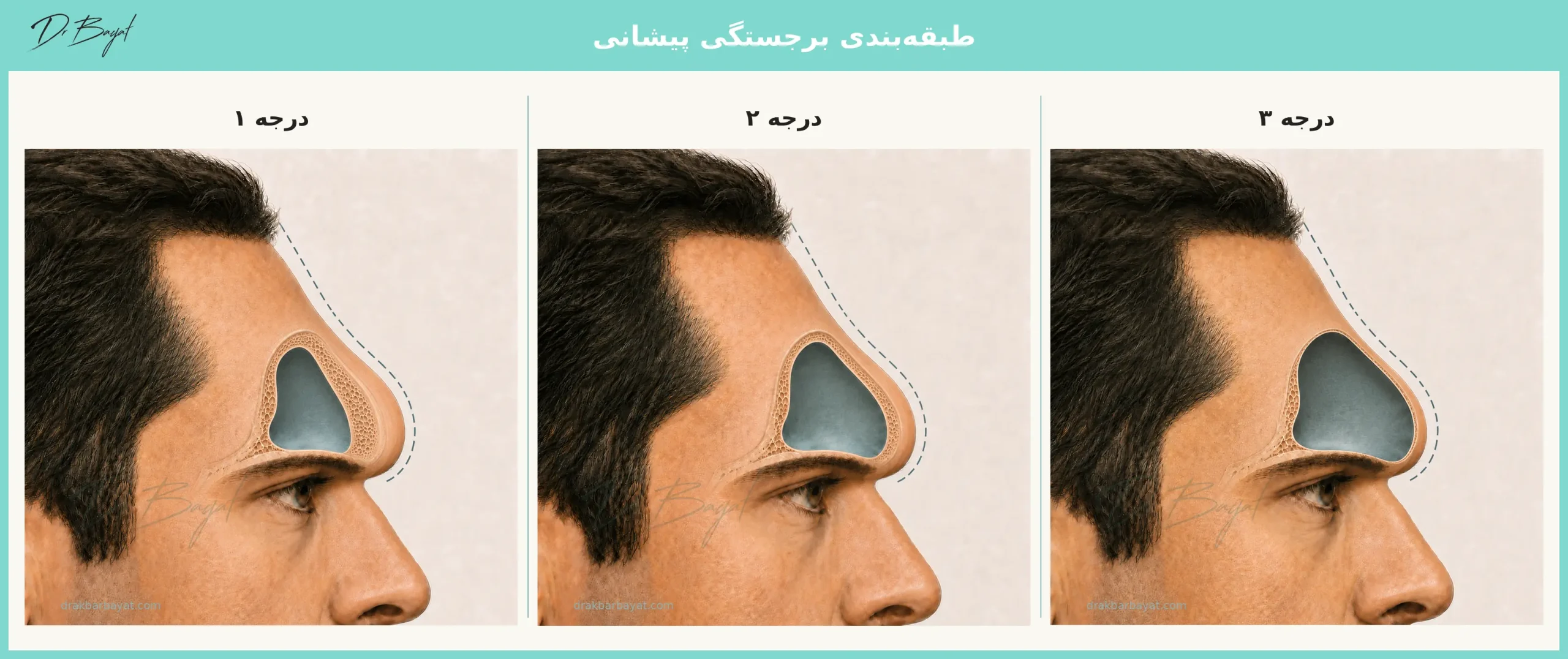 طبقه‌بندی برجستگی پیشانی در انتخاب بهترین جراحان اصلاح پیشانی برجسته