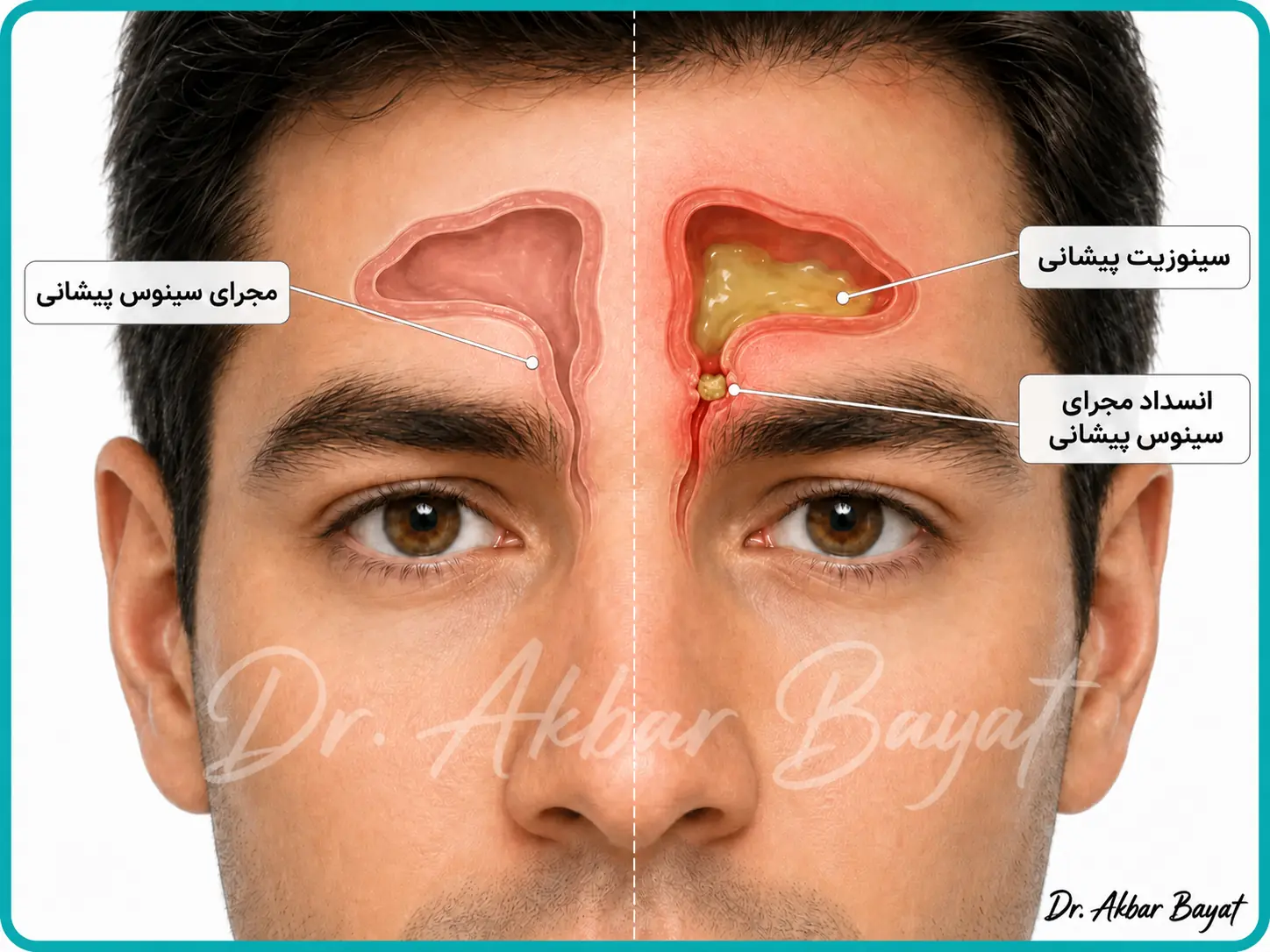 مقایسه مجرای باز سینوس پیشانی با انسداد مجرا و سینوزیت پیشانی